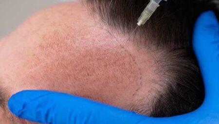 Saç ekimi nasıl yapılır